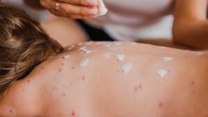 México, epicentro del brote de sarampión en América